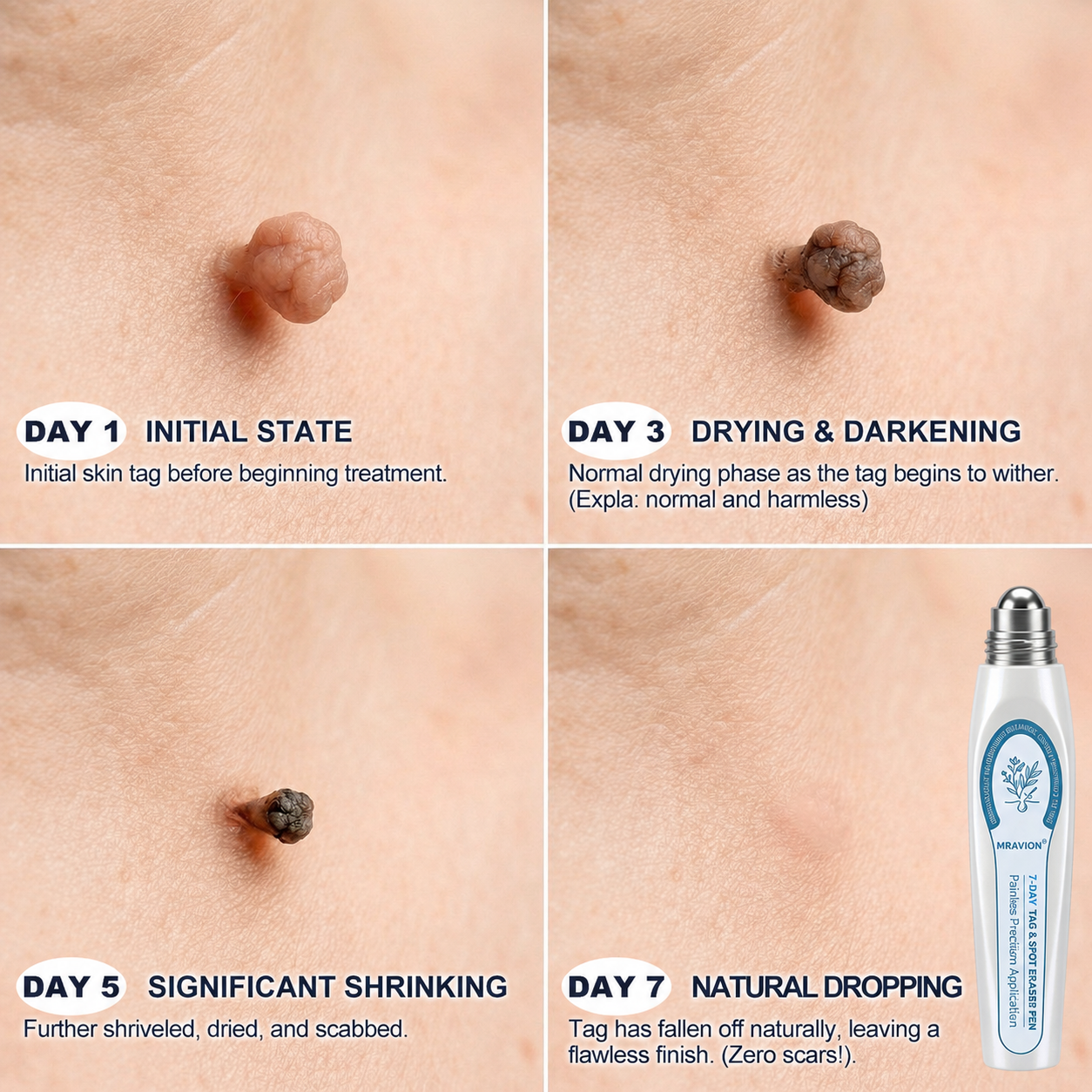 𝐎𝐟𝐟𝐢𝐜𝐢𝐚𝐥 𝐁𝐫𝐚𝐧𝐝 𝐒𝐭𝐨𝐫𝐞 |✅🎉MRAVION® 7-𝐷𝑎𝑦 𝗧𝐚𝐠 & 𝗦𝗽𝐨𝐭 𝐄𝐫𝒂𝒔𝒆𝒓(Zero Pain, Zero 𝐒𝐜𝐚𝒓𝒔 Rollerball)